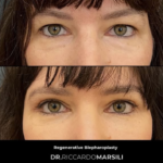 Blépharoplastie Paris