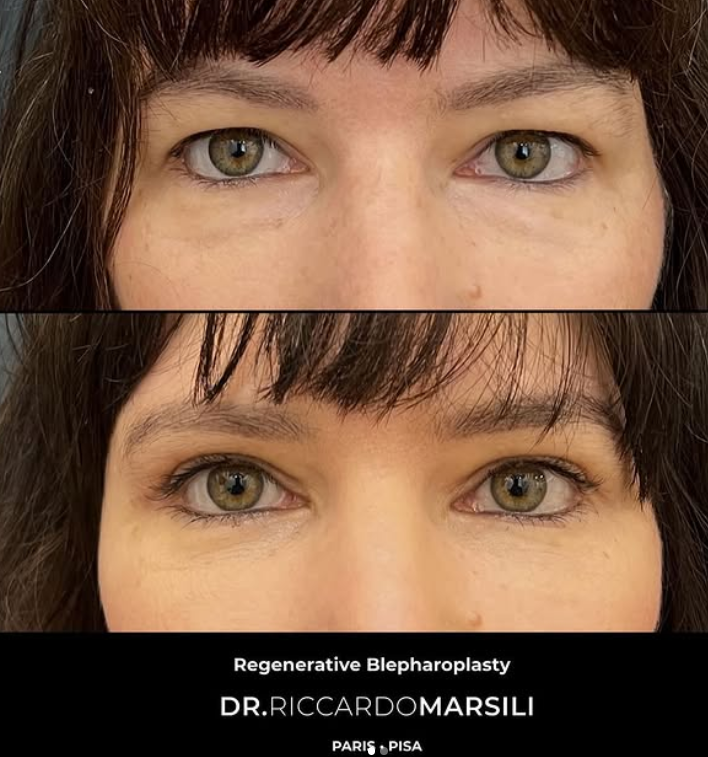 Blépharoplastie Paris