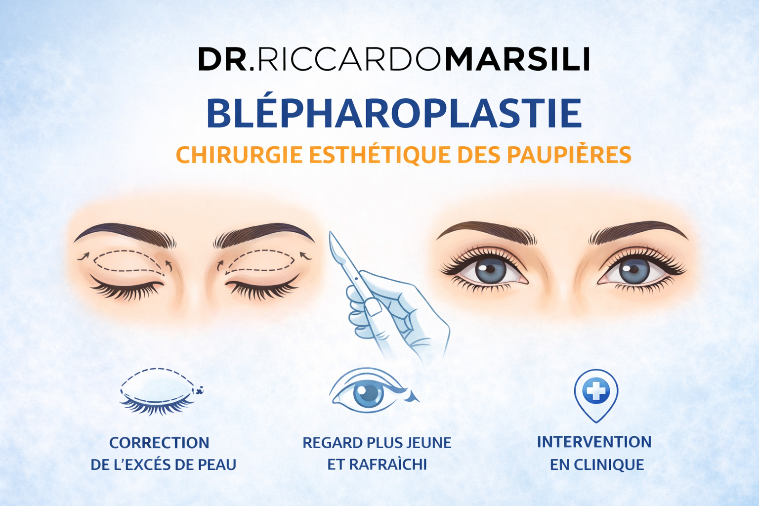 Faire sa blépharoplastie sur Paris 75016