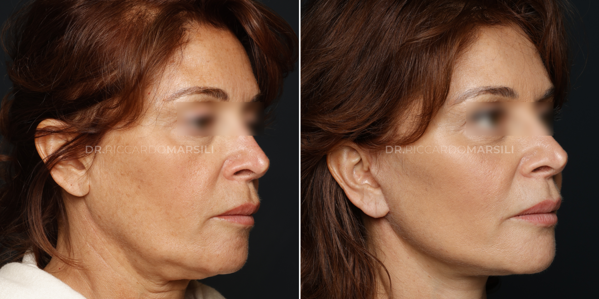 Comment se passe la première consultation de lifting deep plane